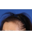 Before Hair Transplant&nbsp;Hair Thinning